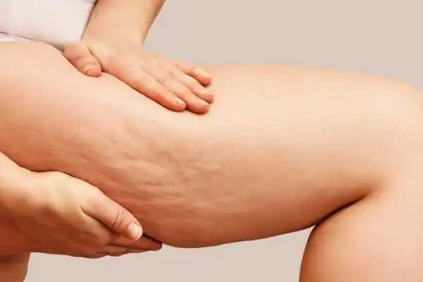 Image of woman showing leg with cellulite Bridport