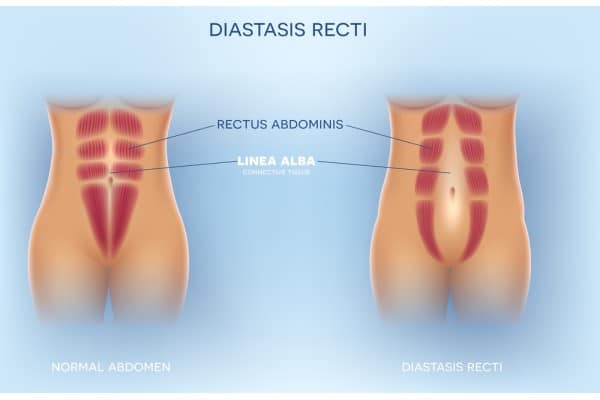 What Non-Surgical Options Are Available for Diastasis Recti Bridport?