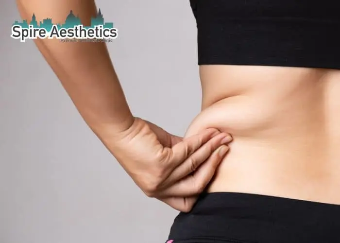 Image of woman pinching fat on their hips Bridport. Fat Freezing treatment