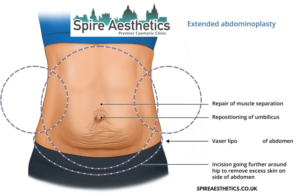 Understanding Loose Skin After Gastric Band Bridport Surgery and HIFU Treatment