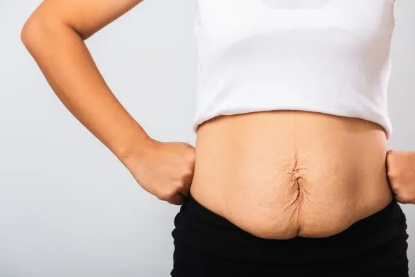 Image of a woman's stomach after weight loss with sagging skin following a gastric band Bridport