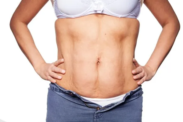 sagging skin on woman's stomach after weight loss injections Bridport