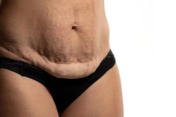 Image of womans stomach after weight loss injections Bridport showing saggy skin